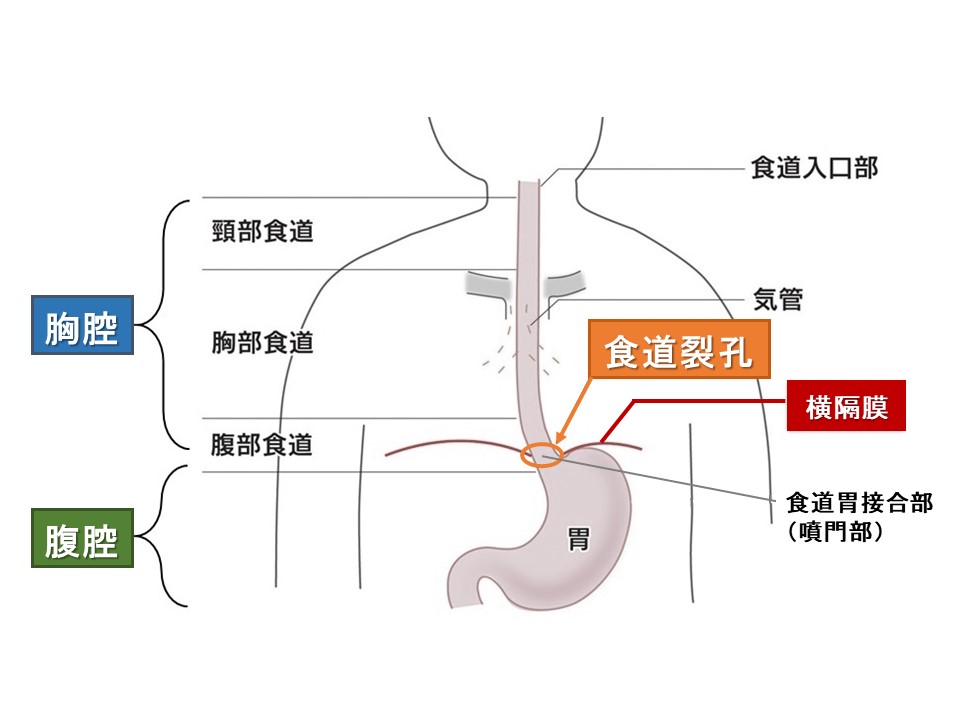 食道裂孔ヘルニアで食べるべき食べ物