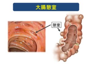 大腸憩室は腸の老化のサイン？ | 阪神西宮駅徒歩30秒の胃カメラ・大腸カメラ｜ひだ胃腸内視鏡クリニック| ひだ胃腸内視鏡クリニック